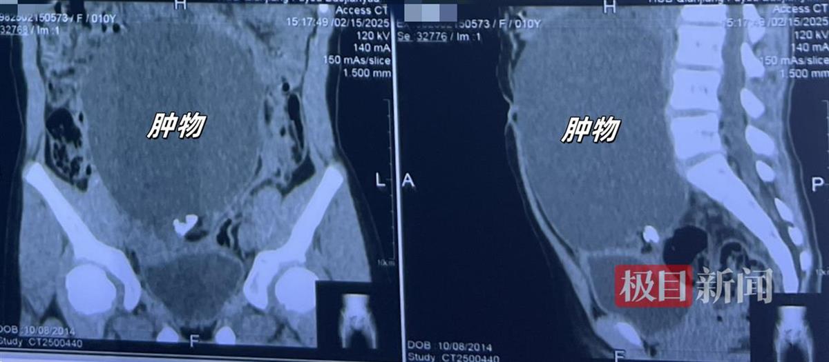 10岁女童持续腹痛、便秘、食欲减退,医生切除15厘米畸胎瘤助其